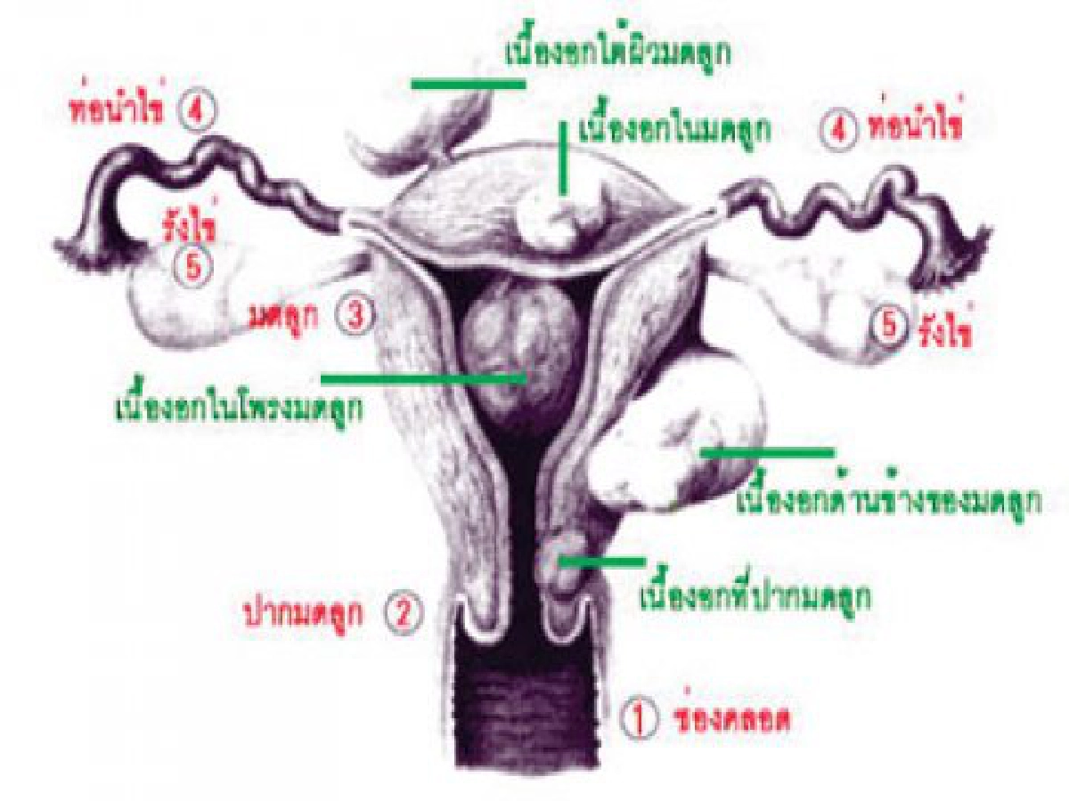 ไขปัญหาสุขภาพแผนจีน - เนื้องอกในมดลูก
ไขปัญหาสุขภาพแผนจีน - เนื้องอกในมดลูก