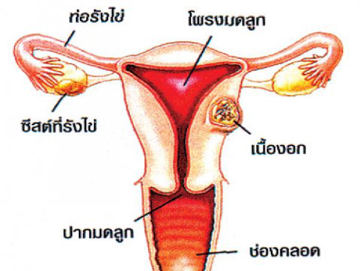 ไขปัญหาสุขภาพแผนจีน - เนื้องอกในมดลูก
ไขปัญหาสุขภาพแผนจีน - เนื้องอกในมดลูก