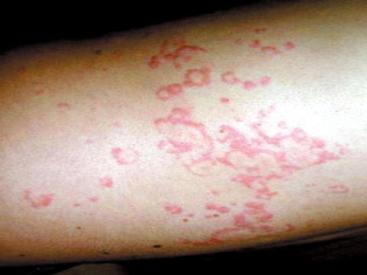 ไขปัญหาสุขภาพแผนจีน - โรคภูมิแพ้รักษาอย่างไรดี

