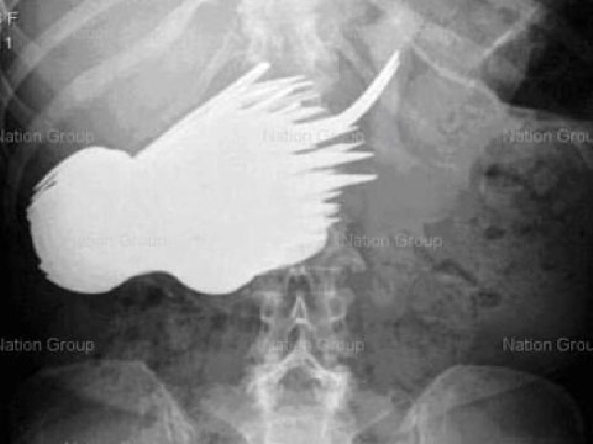 หญิงเนเธอร์แลนด์ชอบกินช้อนกว่า78คัน หญิงเนเธอร์แลนด์ชอบกินช้อนกว่า78คัน