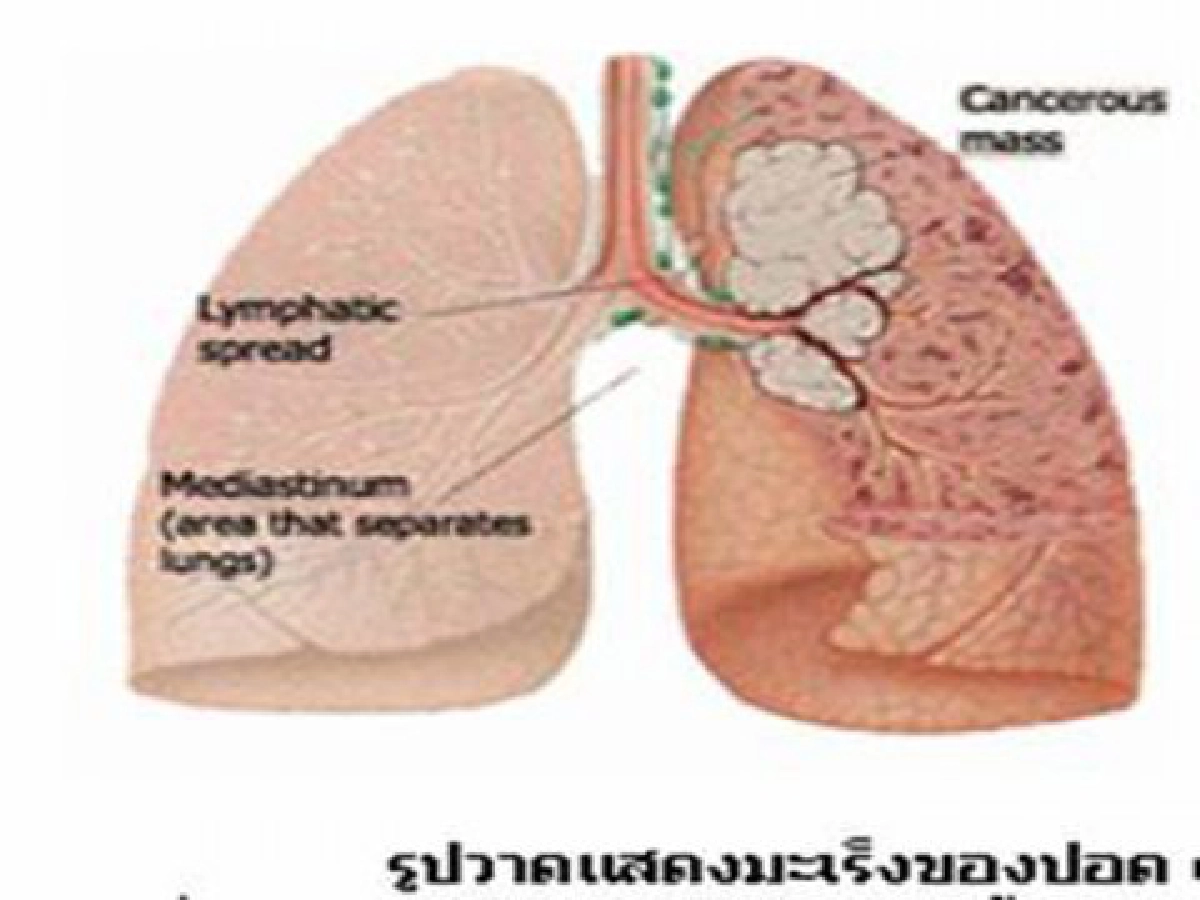 "มะเร็งปอด" เสียชีวิตมาก-เร็ว "มะเร็งปอด" เสียชีวิตมาก-เร็ว