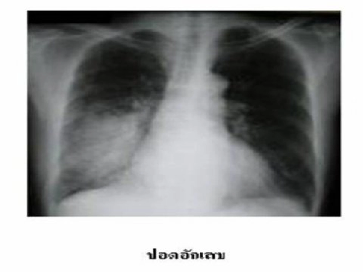 ปอดอักเสบ พบในชายมากกว่าหญิง