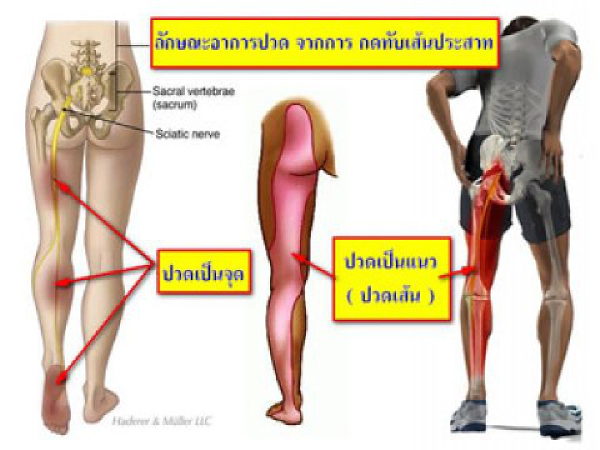 ไขปัญหาสุขภาพแผนจีน - ปวดสะโพกร้าวถึงขา ชาไปที่ปลายเท้า!!

