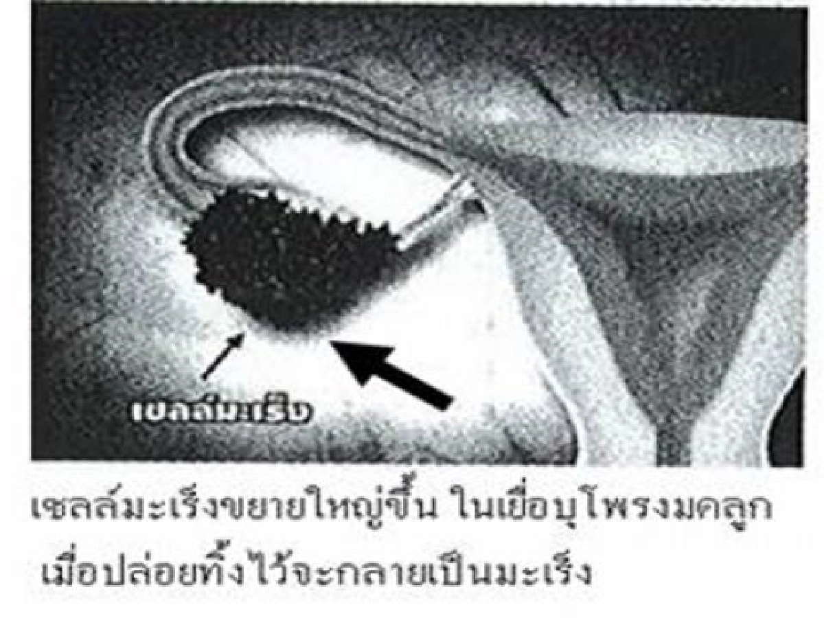 มะเร็งรังไข่ มะเร็งรังไข่