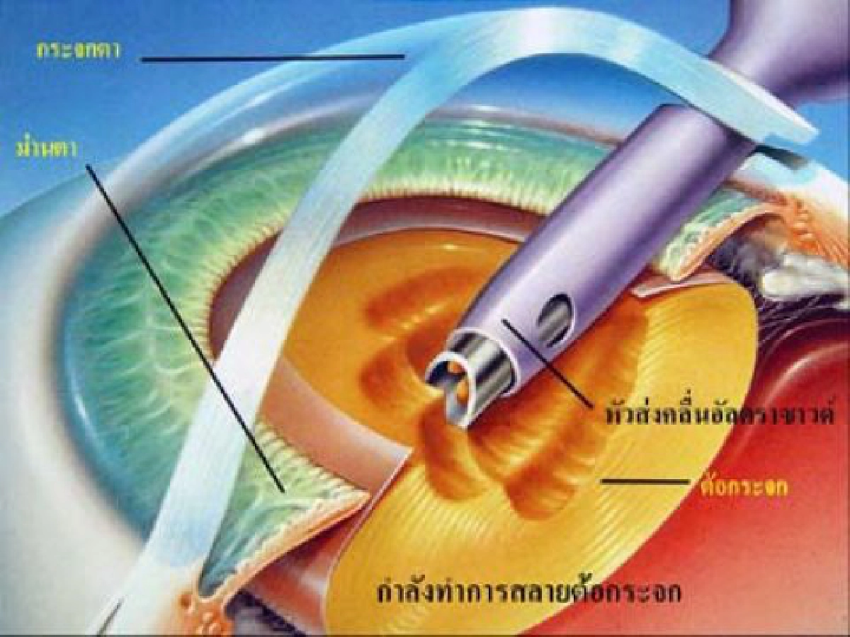 รู้ทัน โรคต้อกระจก