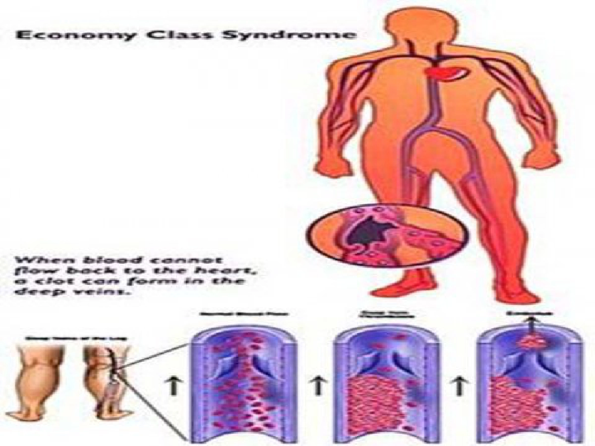 โรคที่มาจาก...นั่งนานเกินไป โรคที่มาจาก...นั่งนานเกินไป