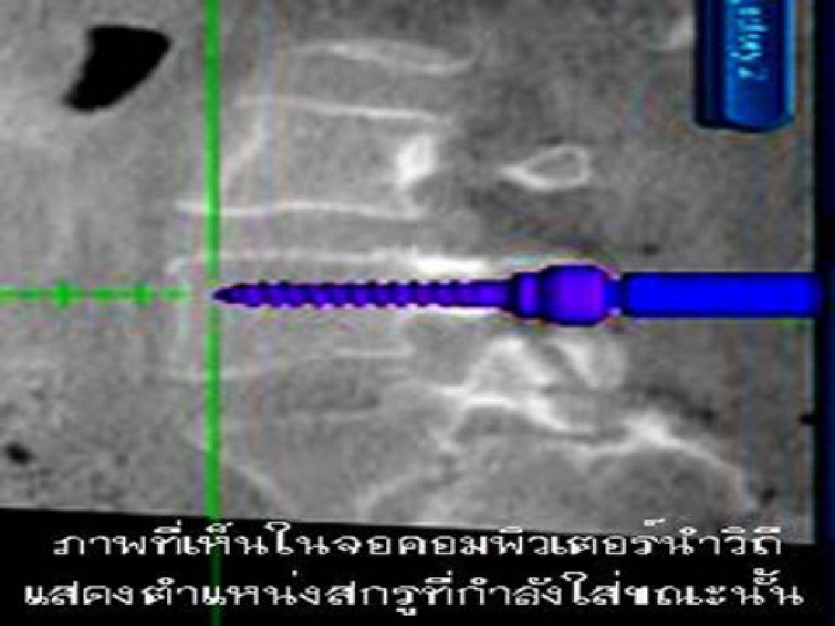เครื่องนำวิถีผ่าตัดข้อและกระดูกสันหลัง