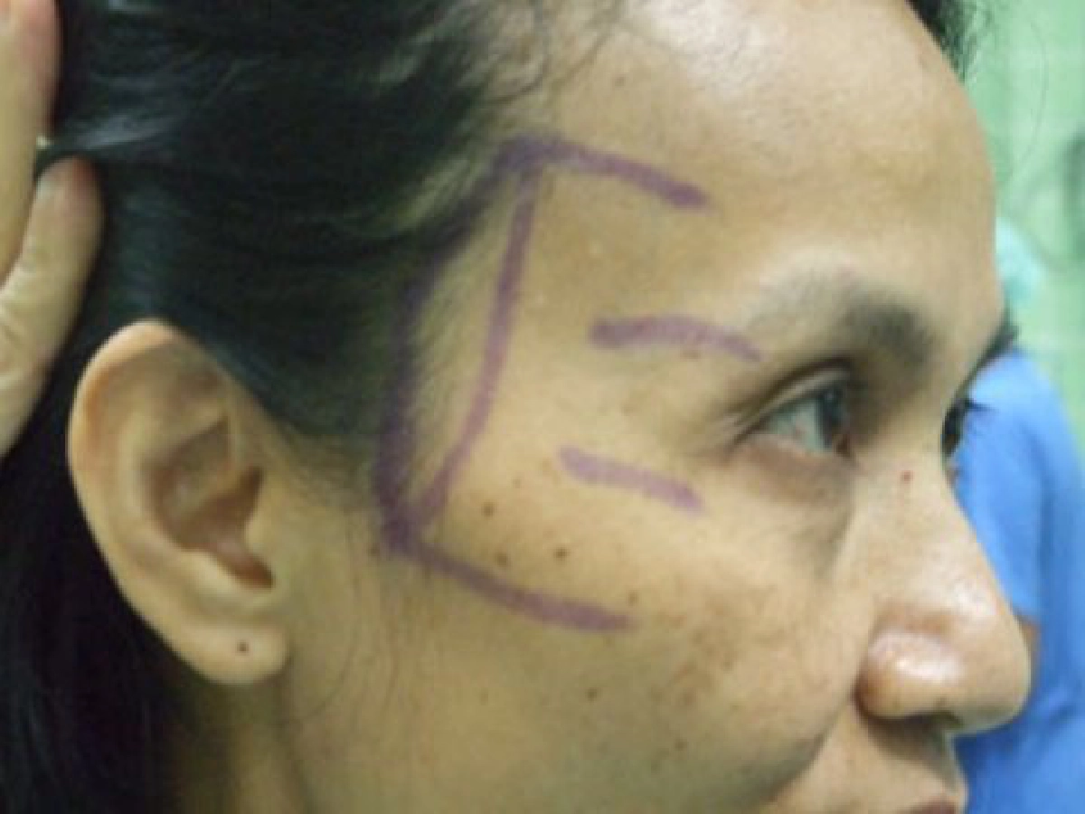 ยกกระชับใบหน้าพาสวยกระชากวัย

