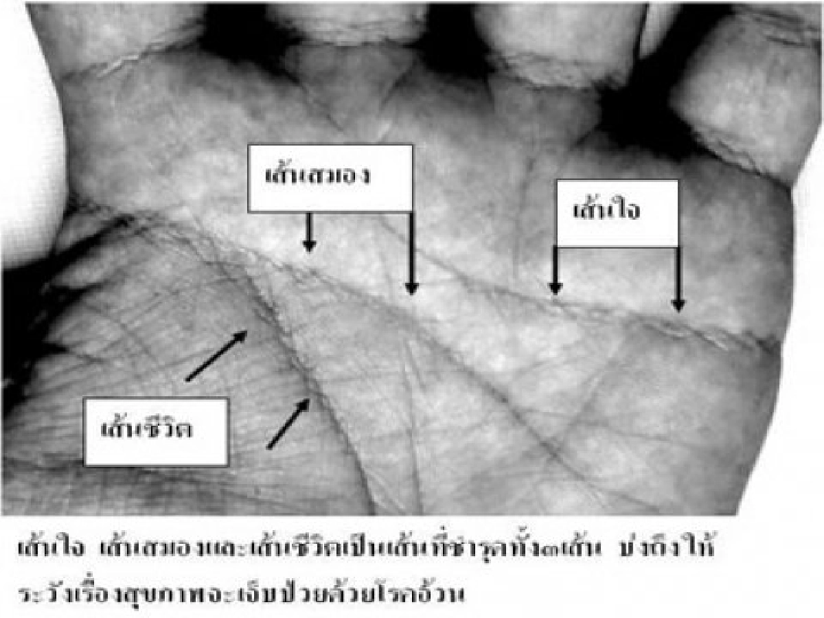 ลายมือบอกโรคได้อย่างไร?