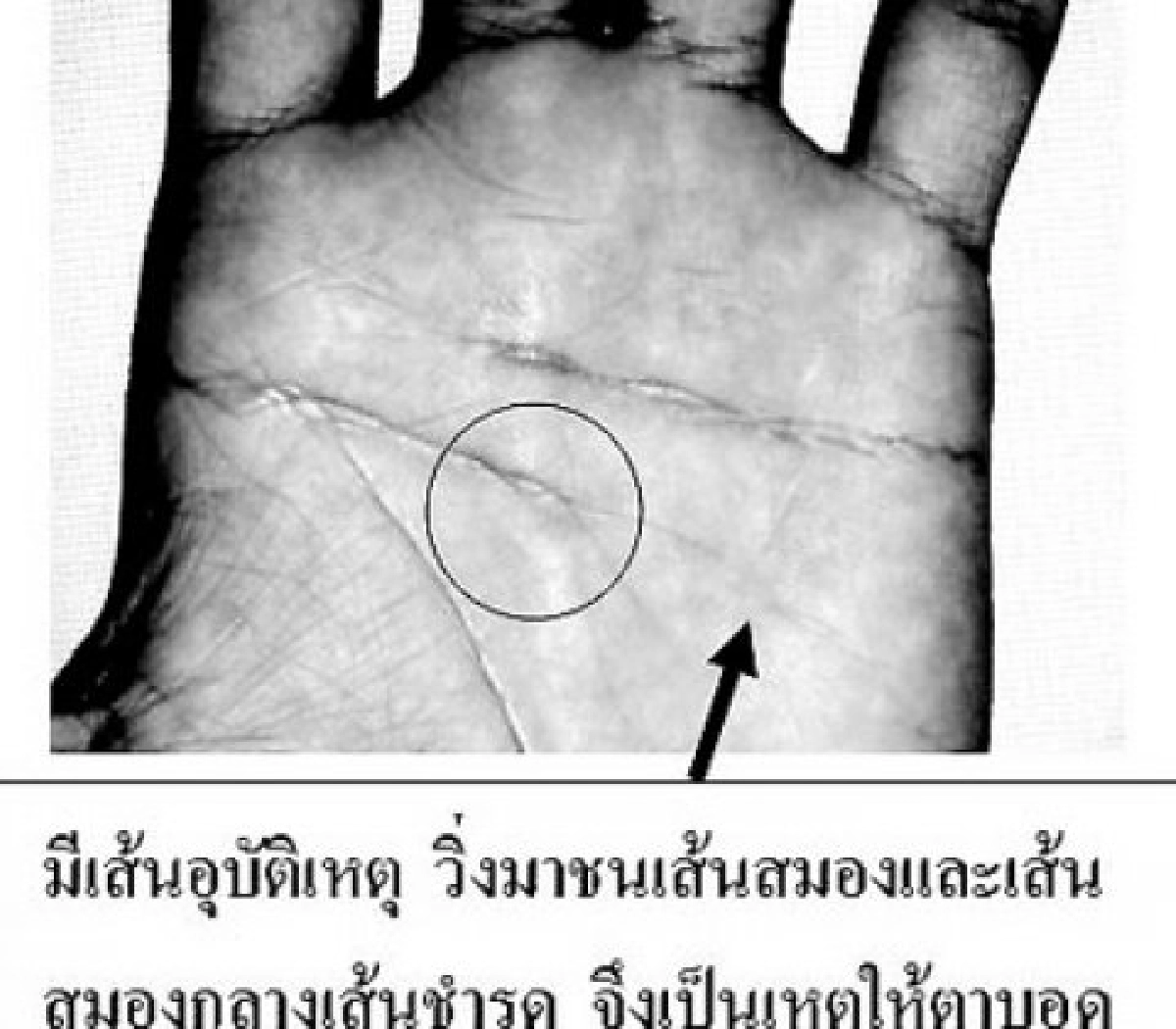 เส้นสมองชำรุดล้มหัวฟาดตาบอด เส้นสมองชำรุดล้มหัวฟาดตาบอด
