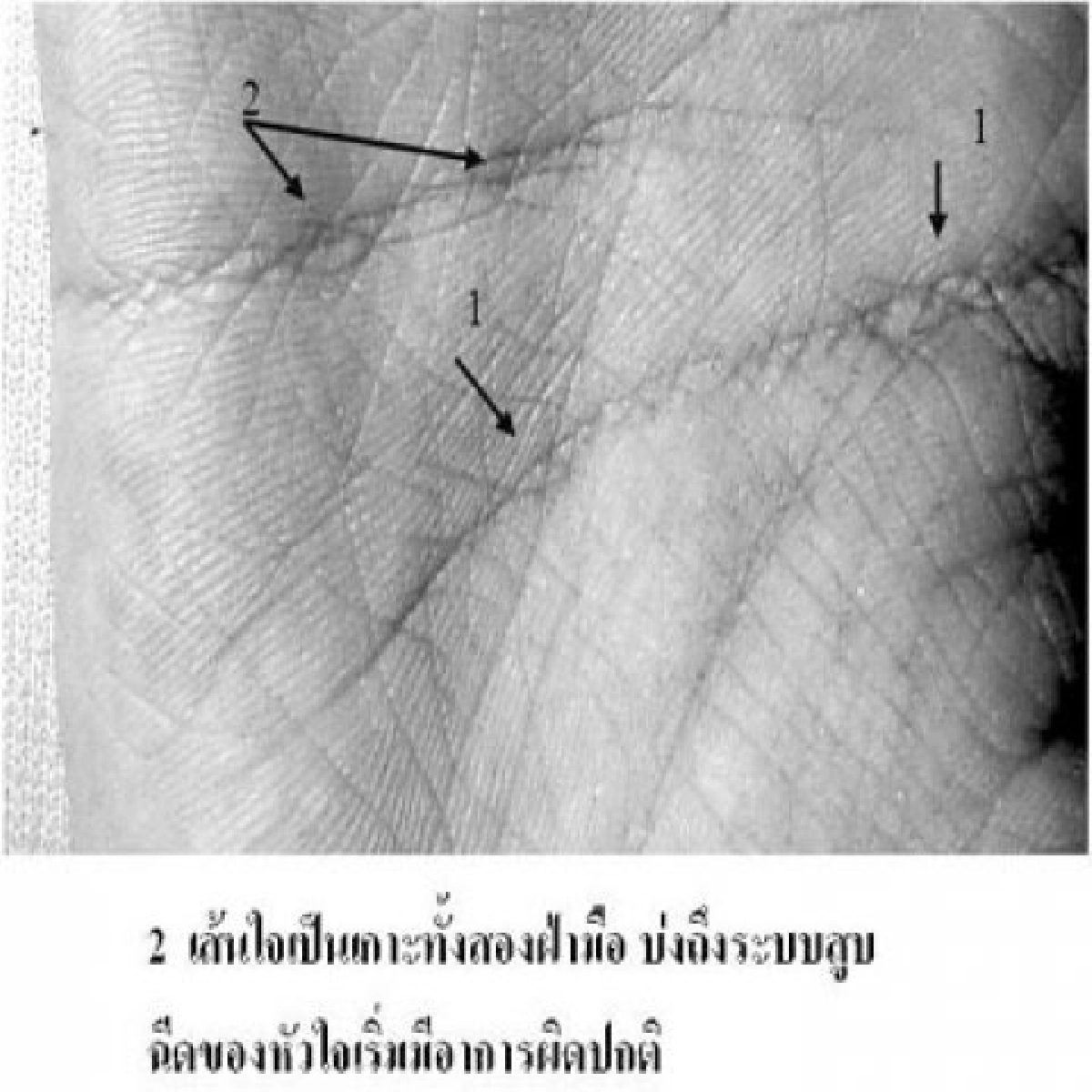 โรคโมยาโมยา โรคโมยาโมยา