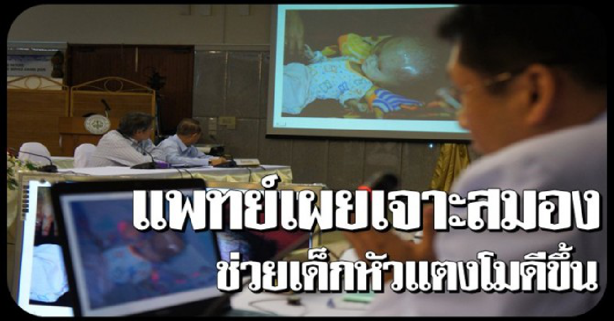 แพทย์เผยเจาะสมองช่วยเด็กหัวแตงโมดีขึ้น 