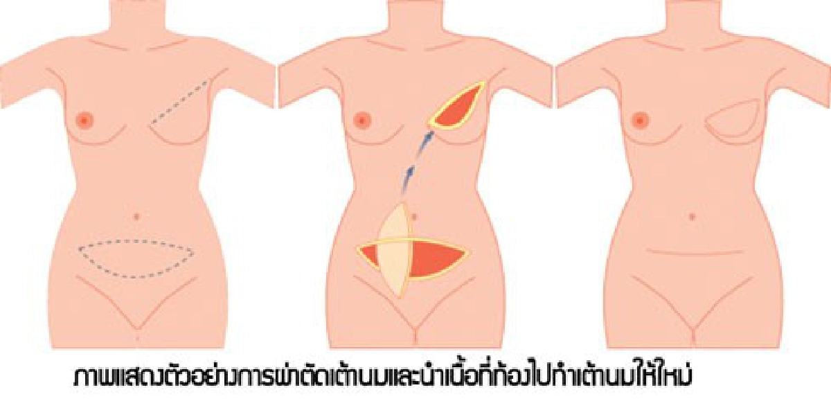 เสริมเต้านมใหม่...มะเร็งเต้านม เสริมเต้านมใหม่...มะเร็งเต้านม