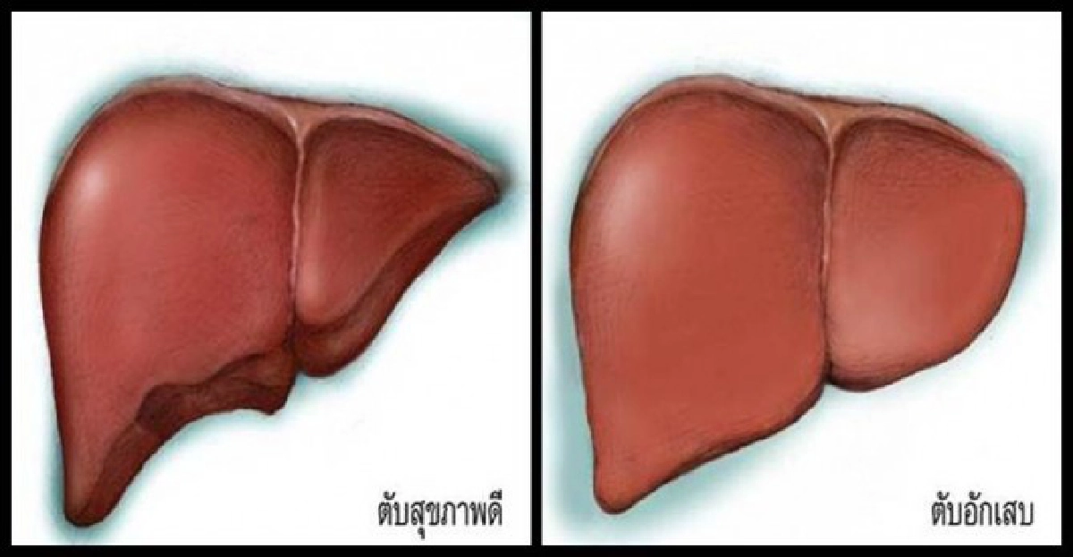 หยุดไวรัสตับอักเสบบีต้านภัยมะเร็งตับ