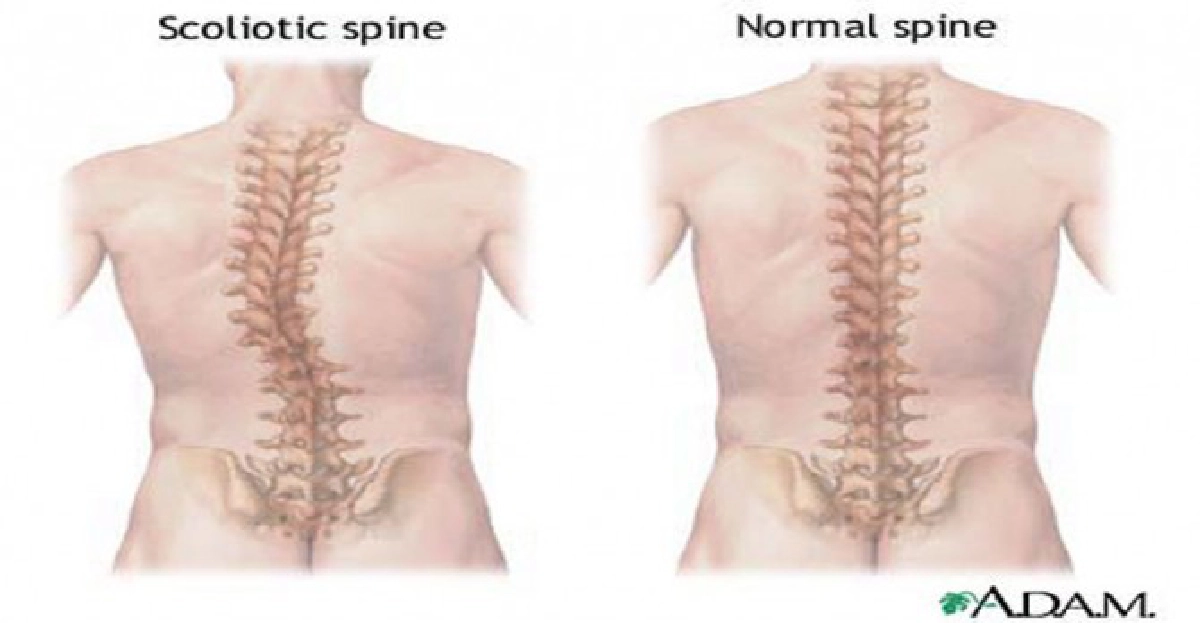 ไขปัญหาสุขภาพ:กระดูกสันหลังคด