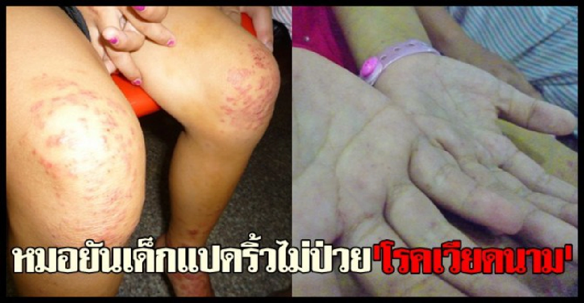 หมอยันเด็กแปดริ้วไม่ป่วย'โรคเวียดนาม' หมอยันเด็กแปดริ้วไม่ป่วย'โรคเวียดนาม'
