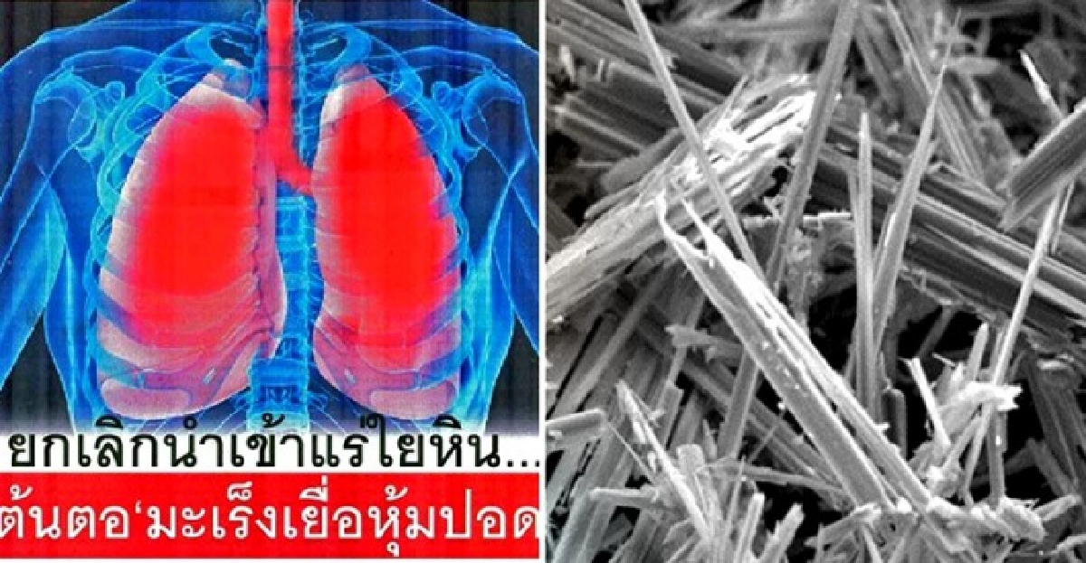 รู้ทันมะเร็ง : แร่ใยหินตัวการมะเร็งปอด รู้ทันมะเร็ง : แร่ใยหินตัวการมะเร็งปอด