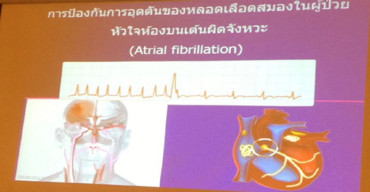 Stop...อัมพฤกษ์ อัมพาต 