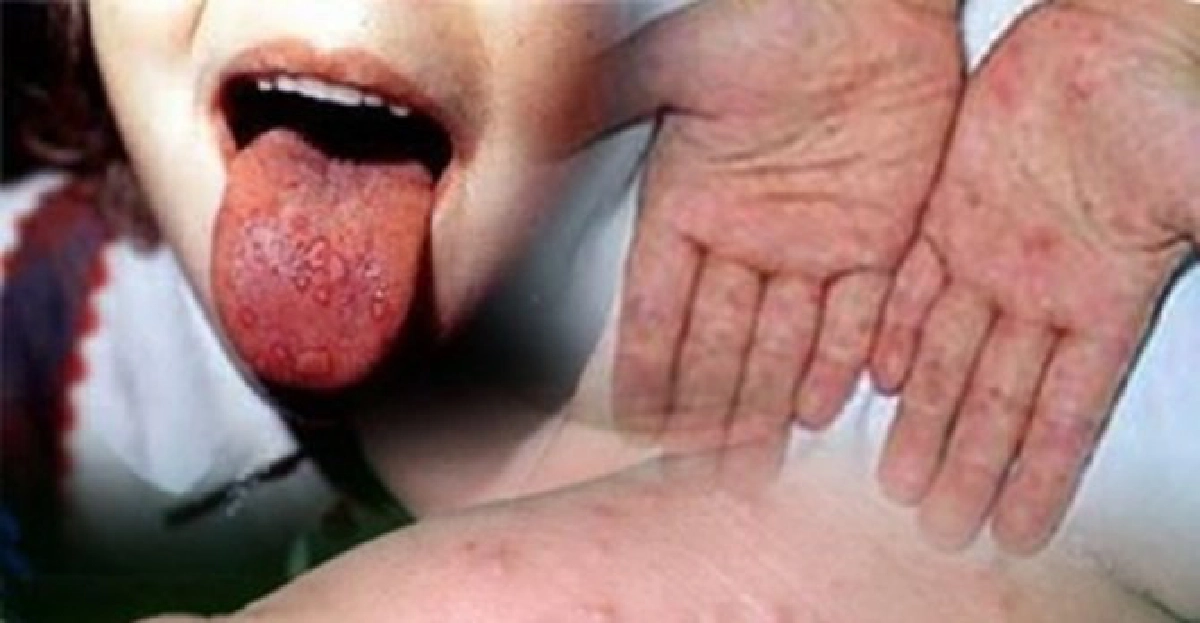 'มือเท้าปาก'พิษณุโลกป่วยพุ่ง537ราย