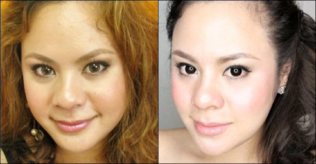 'ปรับรูปหน้าเรียว'เทรนด์หญิงยุคนี้
