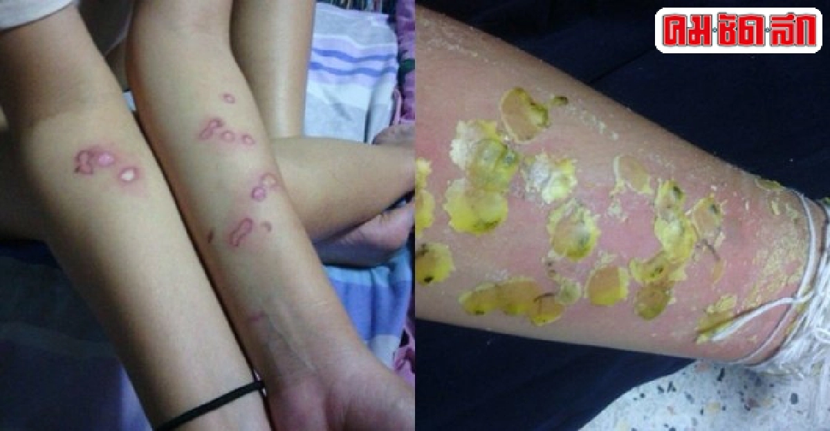 รับน้องโหด!น้ำตาเทียนหยดใส่แขนพอง รับน้องโหด!น้ำตาเทียนหยดใส่แขนพอง
