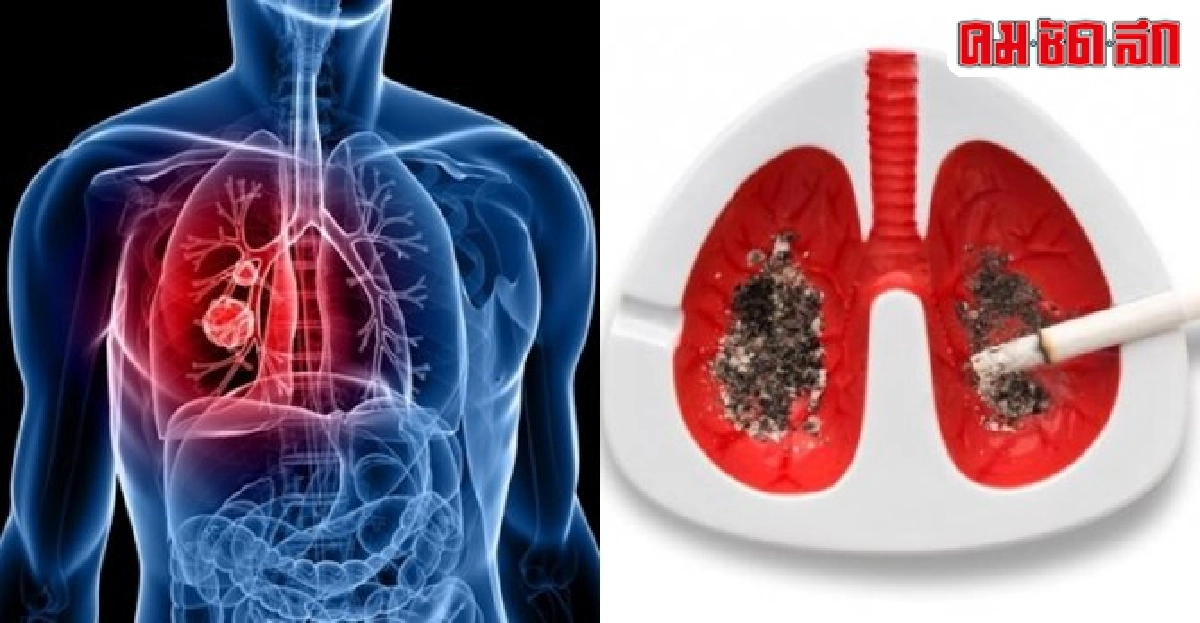 พฤศจิกายนเดือนต้านภัยมะเร็งปอด