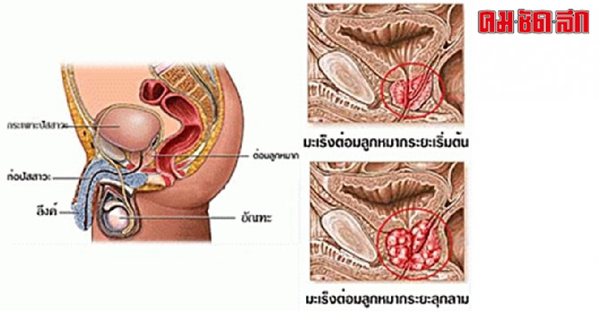 มะเร็งต่อมลูกหมาก...ภัยเงียบสำหรับชายสูงวัย มะเร็งต่อมลูกหมาก...ภัยเงียบสำหรับชายสูงวัย