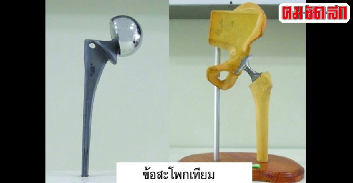 ดูแลสุขภาพ : กระดูกสะโพกหัก ดูแลสุขภาพ : กระดูกสะโพกหัก