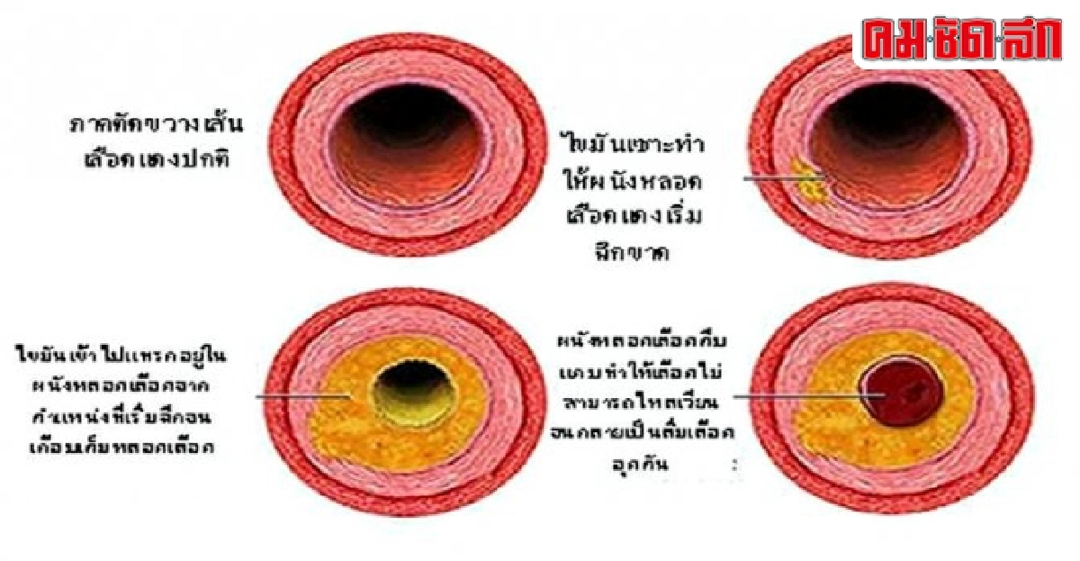 ส้มตำช่วยลดไขมันในเลือด ส้มตำช่วยลดไขมันในเลือด