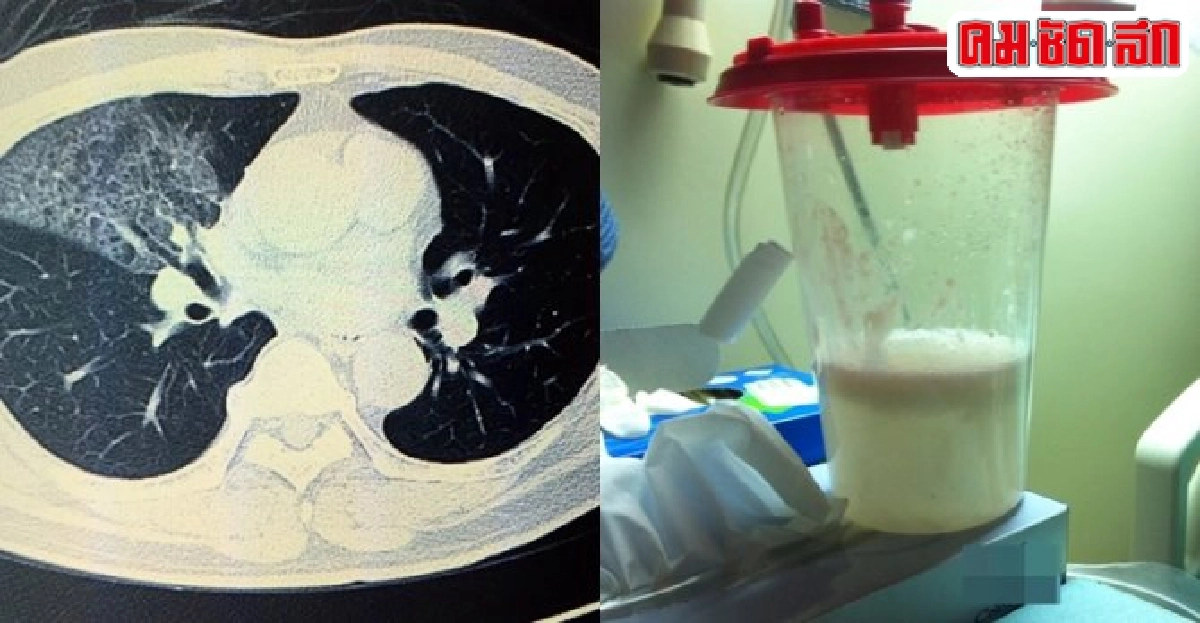 เตือนภัย!!น้ำมันมะพร้าวสกัดเย็น...เสี่ยงโรคปอดอักเสบ  