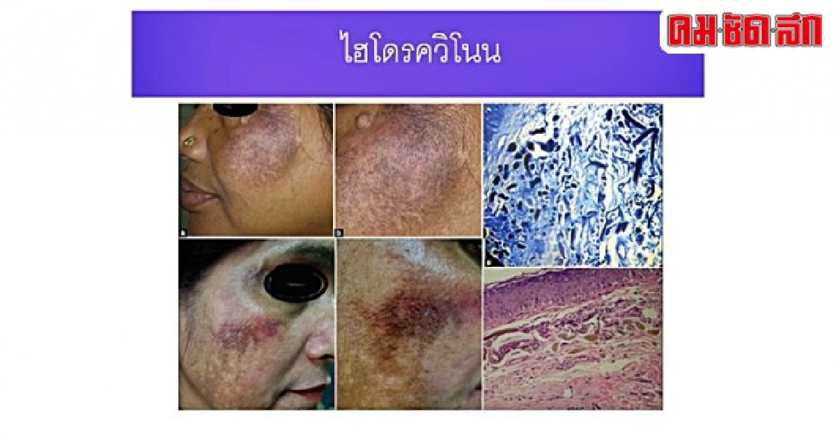 หยุดเสี่ยง...เลี่ยงซื้อผลิตภัณฑ์ผิวขาว(จบ) หยุดเสี่ยง...เลี่ยงซื้อผลิตภัณฑ์ผิวขาว(จบ)