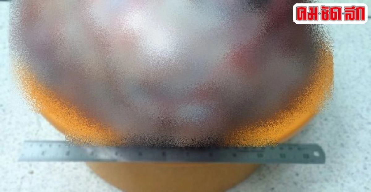 ผงะ!ผ่าตัดสาวท้องโตเจอก้อนเนื้องอกหนัก34กก.