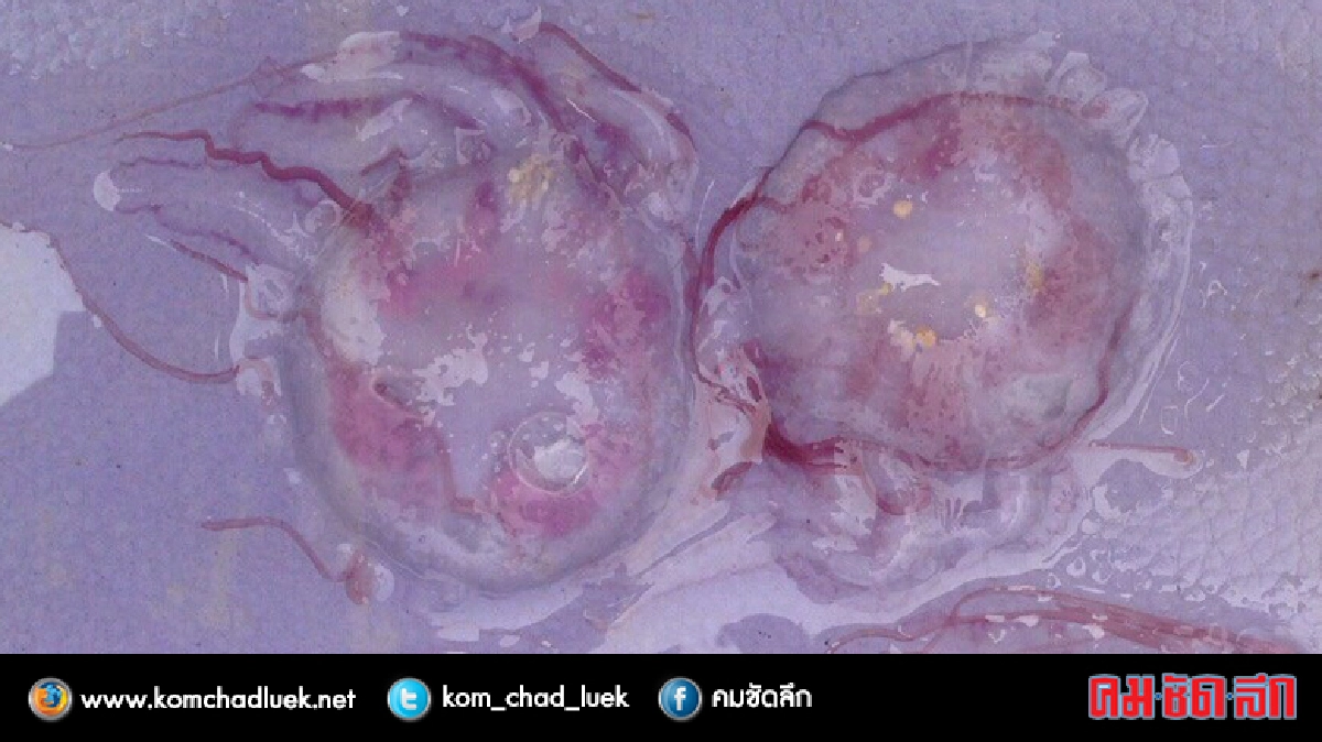2 ขวบรัสเซียเล่นน้ำโคม่าโดนพิษแมงกะพรุนกล่อง 2 ขวบรัสเซียเล่นน้ำโคม่าโดนพิษแมงกะพรุนกล่อง