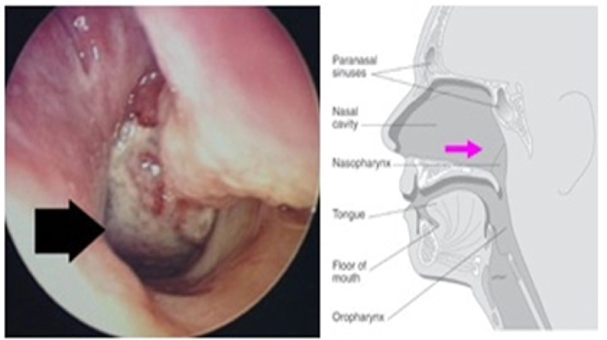 เตือนภัย!!...มะเร็งหลังโพรงจมูก เตือนภัย!!...มะเร็งหลังโพรงจมูก