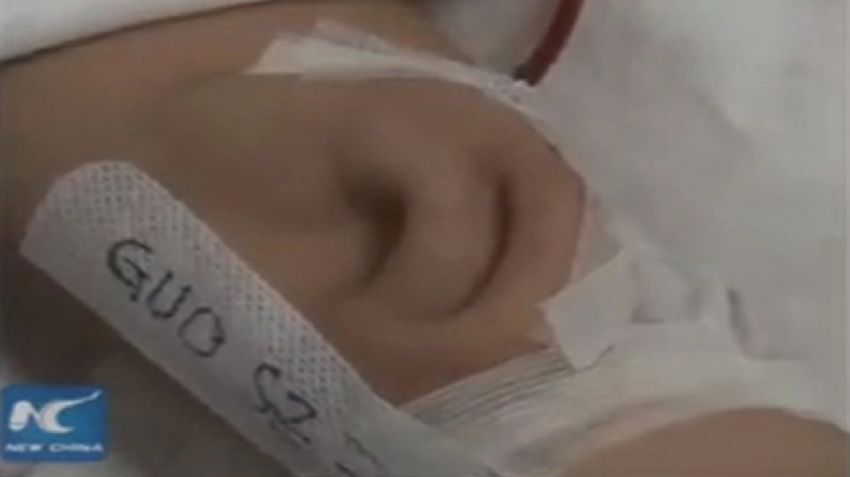 ปลูกหูไว้ที่ปลายแขน!? ปลูกหูไว้ที่ปลายแขน!?