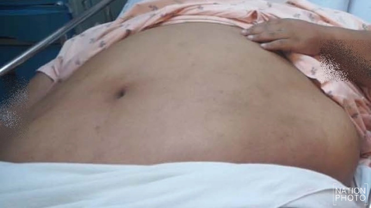 วอนช่วยเหลือ!!อ้วน250กก.กลัวท้องแตกตาย