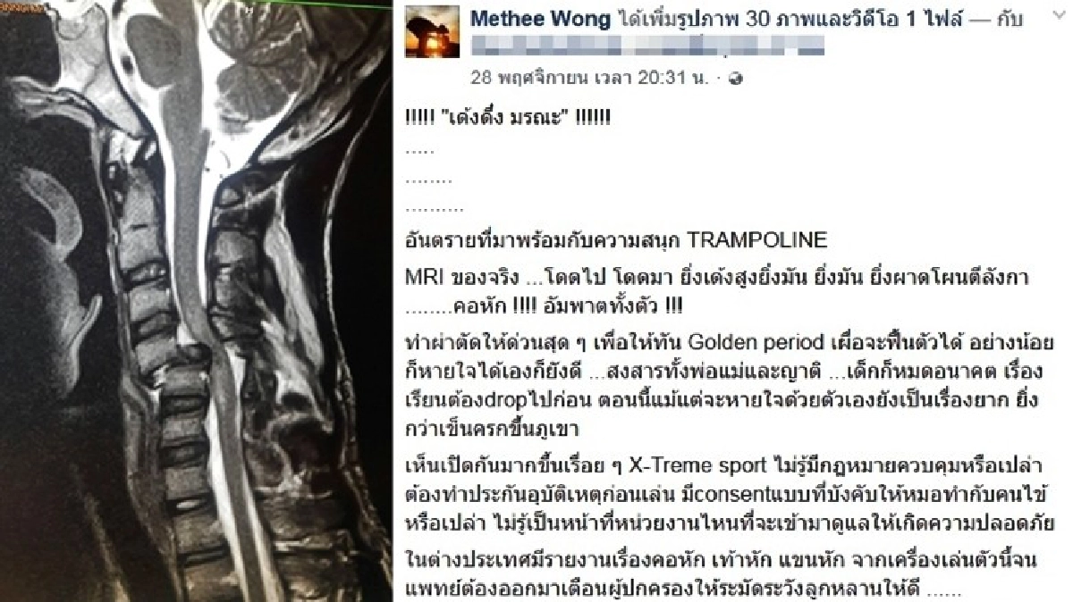 ‘แทรมโพลีน’เครื่องเล่นมรณะ! เสี่ยงคอหัก-อัมพาต ‘แทรมโพลีน’เครื่องเล่นมรณะ! เสี่ยงคอหัก-อัมพาต