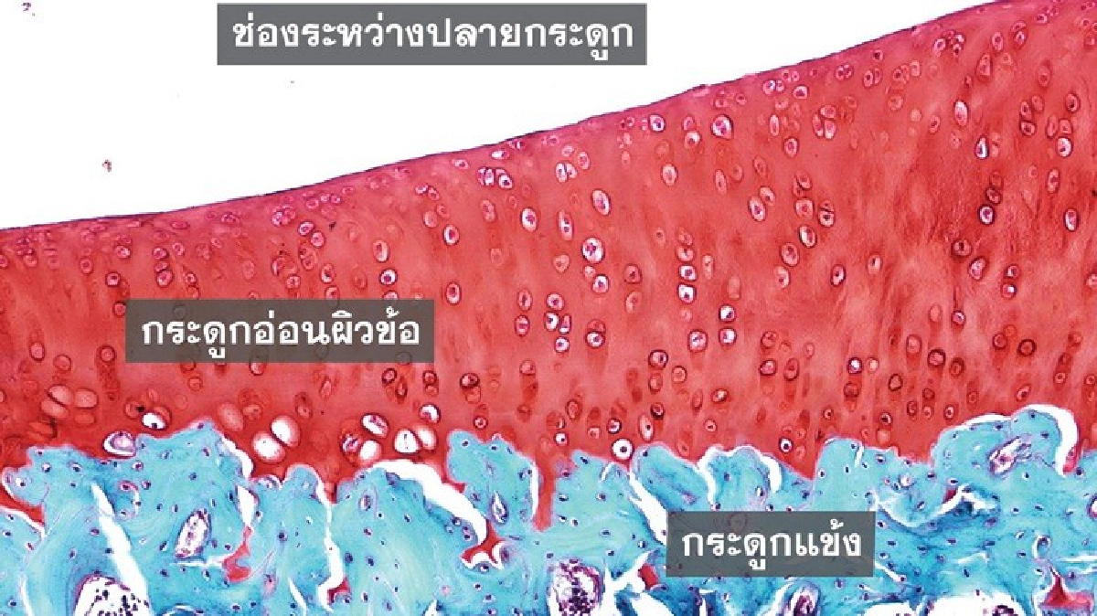 เมนูดูแล"เข่า" เข้าใจ ป้องกันได้ เมนูดูแล"เข่า" เข้าใจ ป้องกันได้