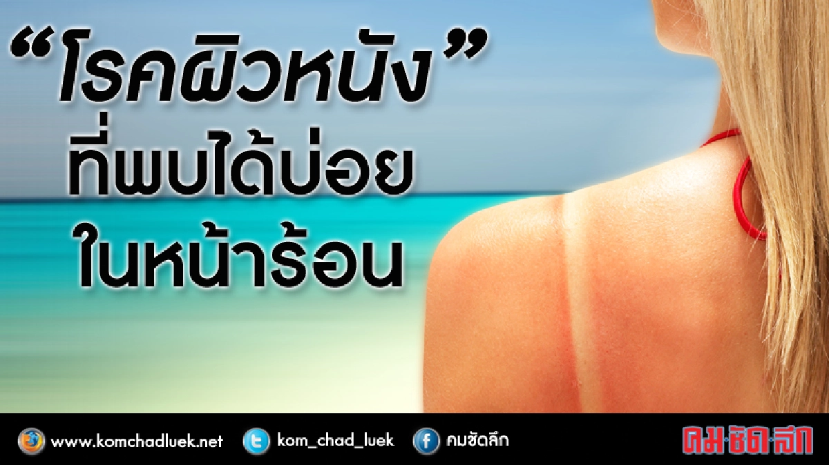 โรคผิวหนังที่พบได้บ่อยหน้าร้อน