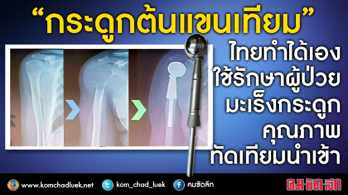 ไทยทำได้!! ผลิตกระดูกต้นแขนเทียมเองครั้งแรก ไทยทำได้!! ผลิตกระดูกต้นแขนเทียมเองครั้งแรก