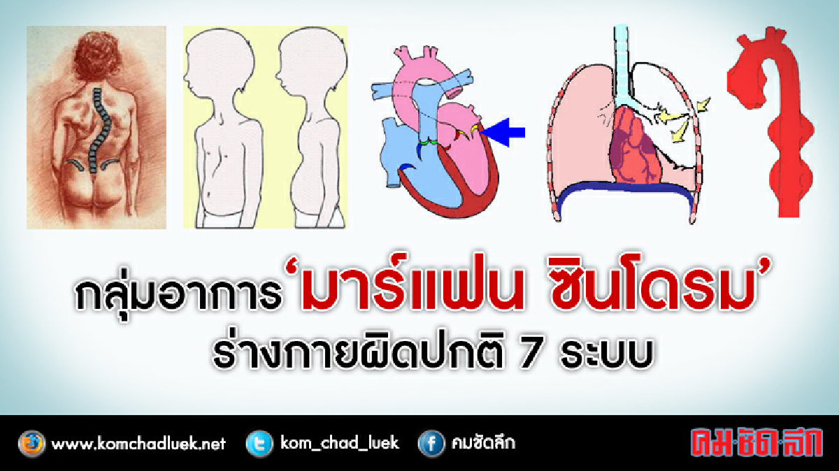 “มาร์แฟน ซินโดรม”ร่างกายผิดปกติ7ระบบ กลุ่มอาการที่นายแบบเป็น “มาร์แฟน ซินโดรม”ร่างกายผิดปกติ7ระบบ กลุ่มอาการที่นายแบบเป็น