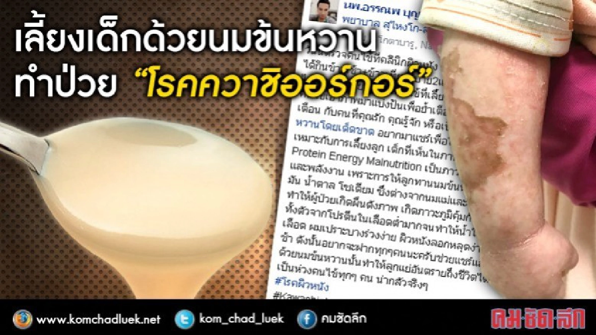 เด็กน้อยป่วย“โรคควาชิออร์กอร์” เพราะกินนมข้นหวาน! เด็กน้อยป่วย“โรคควาชิออร์กอร์” เพราะกินนมข้นหวาน!