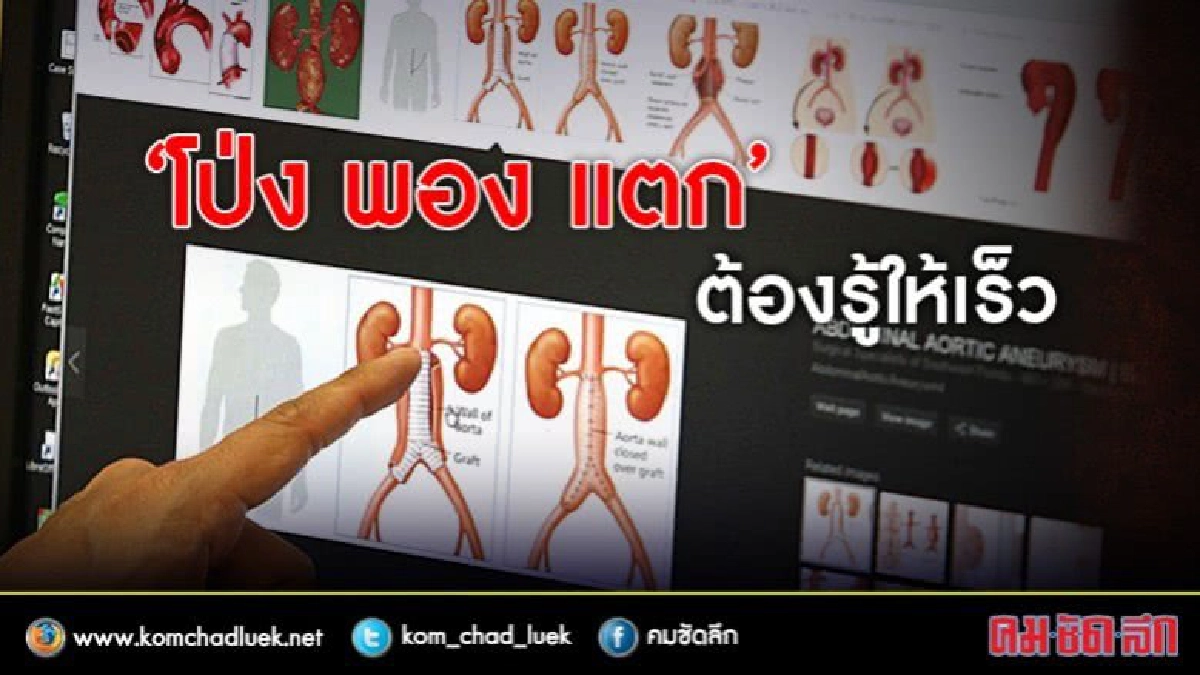 ‘โป่ง พอง แตก’ ตรวจรักษาได้เร็วรอดชีวิตสูง