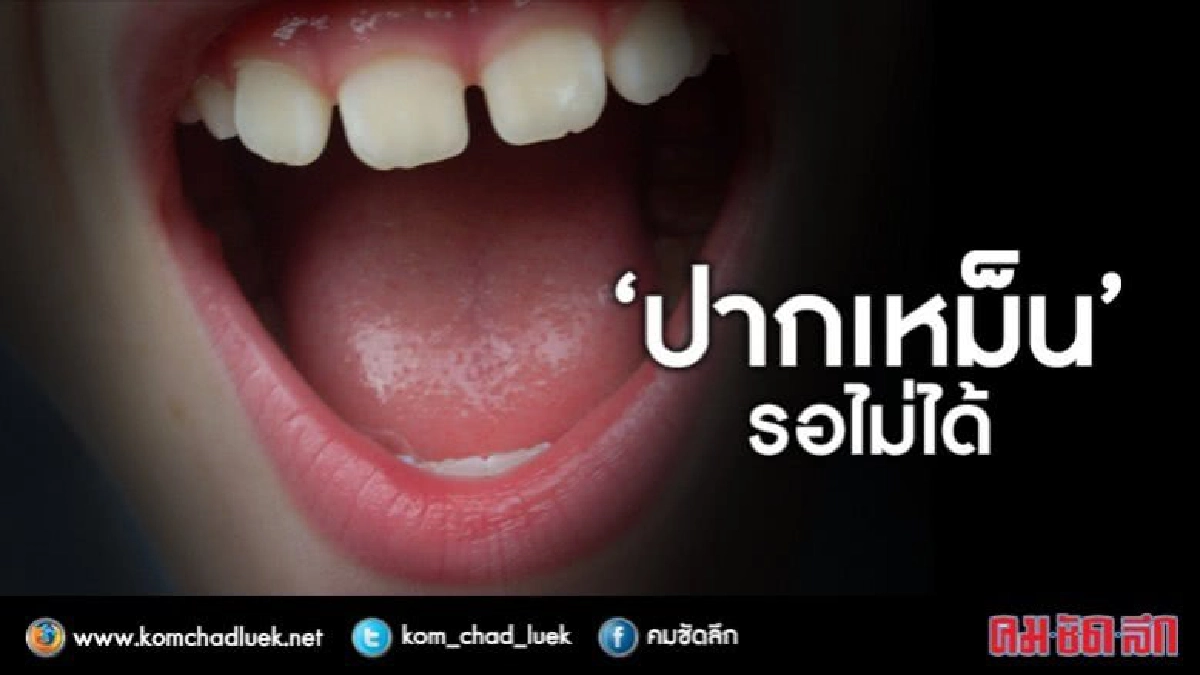 กรมอนามัยเผยวิธีแก้กลิ่นปากเหม็น กรมอนามัยเผยวิธีแก้กลิ่นปากเหม็น