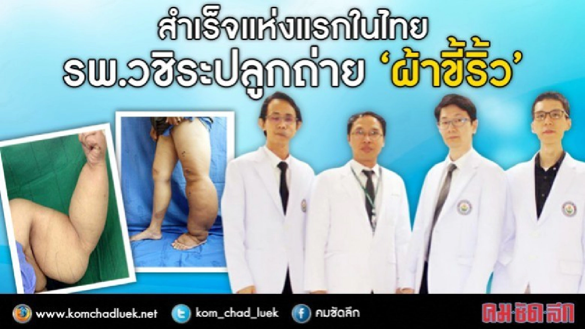 "รพ.วชิระ"ทำสำเร็จปลูกถ่ายเนื้อเยื่อน้ำเหลือง     