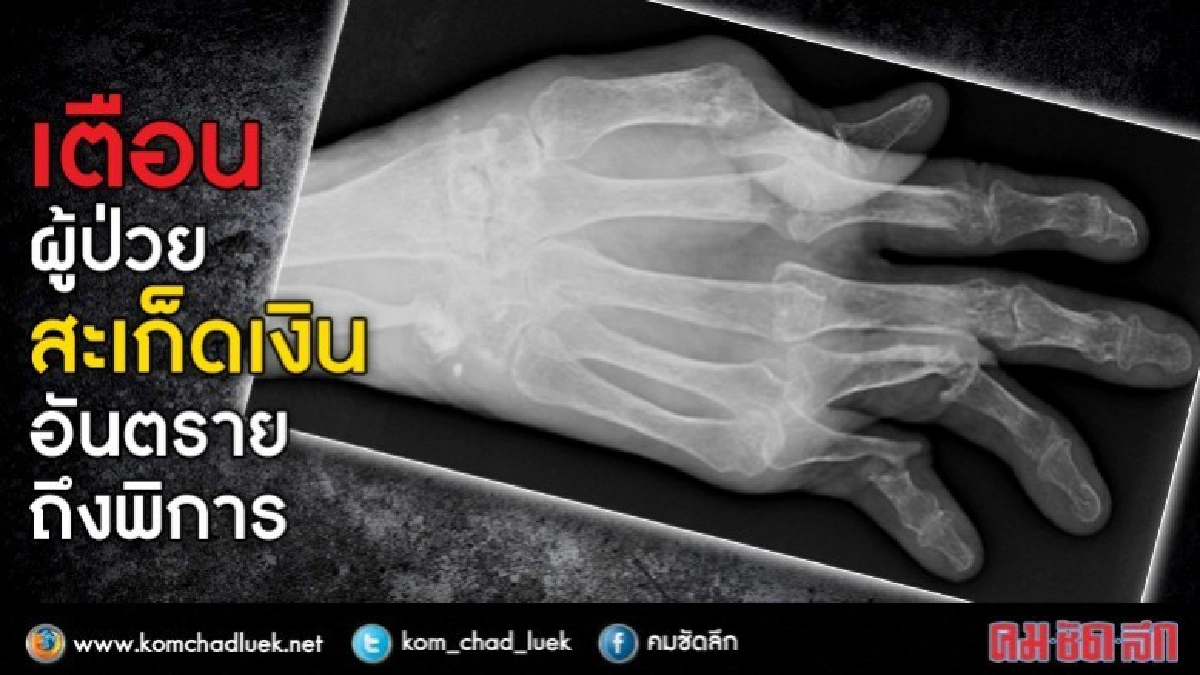 ระวัง! เสี่ยง "ข้ออักเสบสะเก็ดเงิน" ระวัง! เสี่ยง "ข้ออักเสบสะเก็ดเงิน"