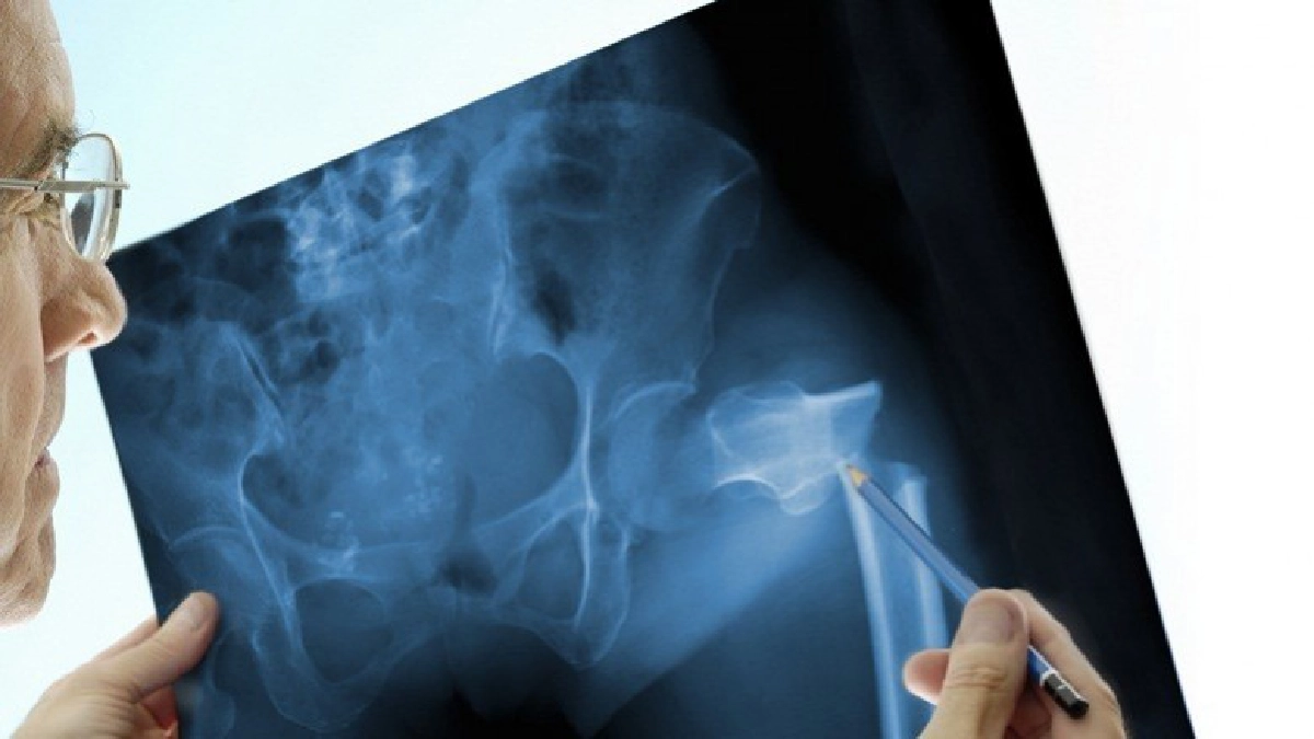 'กระดูกพรุน' ภัยร้าย!!คนสูงวัย 