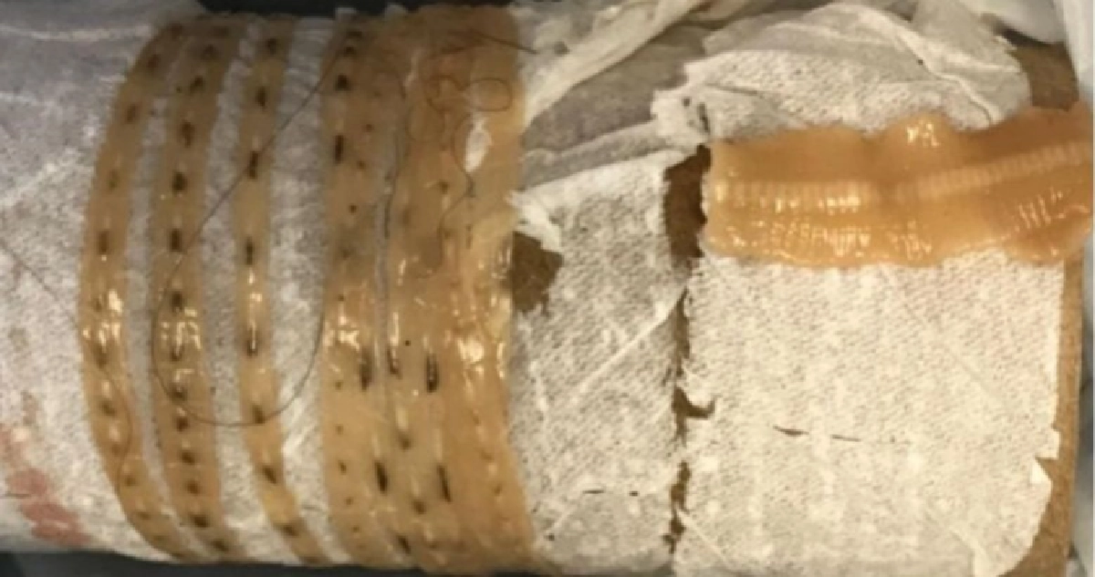 ‘ซูชิ’ แซลมอนเป็นเหตุติดพยาธิตัวตืด 1.6 เมตร ‘ซูชิ’ แซลมอนเป็นเหตุติดพยาธิตัวตืด 1.6 เมตร