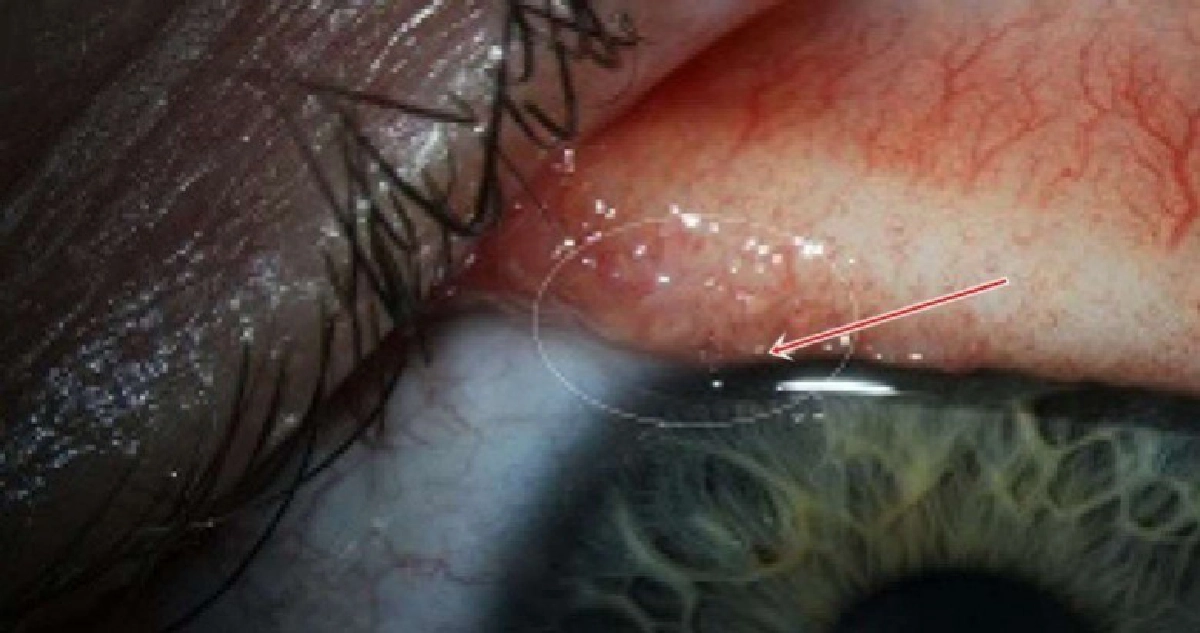 พบ “หนอนพยาธิวัว” ในดวงตาคนครั้งแรก พบ “หนอนพยาธิวัว” ในดวงตาคนครั้งแรก