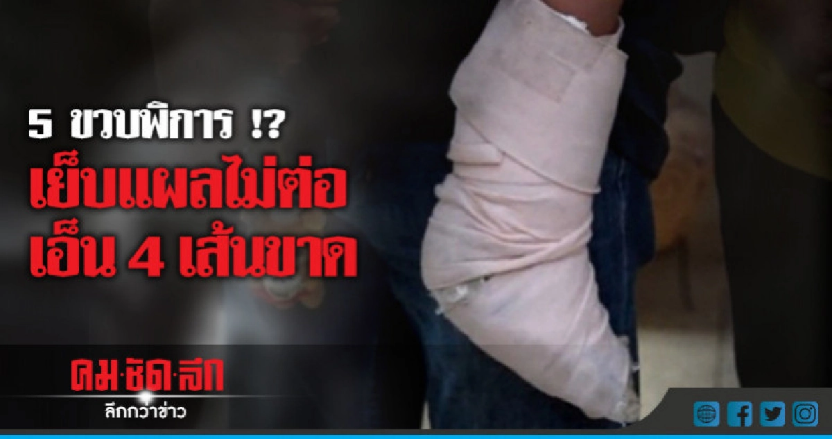 2 สัปดาห์รู้ผลสอบเย็บแผลไม่ต่อเอ็น